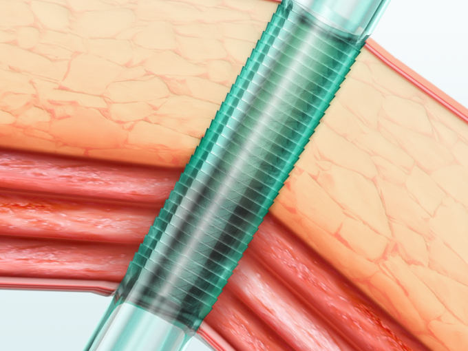 الـ " تـروكـار " البصري القابل للتعقيم والـ " كانولا " للـ " لابروسكوبـي " جراحة المريض الواحد 0