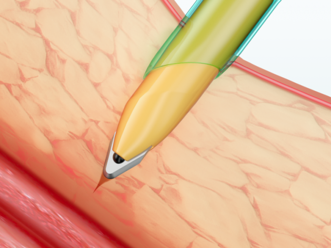 أدوات تنظير البطن يمكن التخلص منها بقنية مع شفرة 1