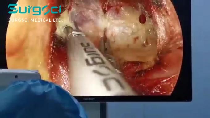 آخر أخبار الشركة فيديو تطبيق المبضع بالموجات فوق الصوتية | إزالة آفة الغدة الدرقية بالمنظار | سورجشي  0