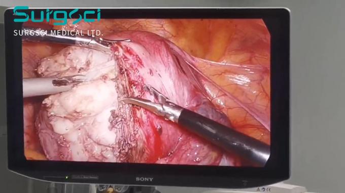 آخر أخبار الشركة فهم آفات الرحم: الأسباب وخيارات العلاج | سورجشي 0