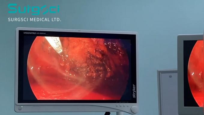 آخر أخبار الشركة الفتق: الأسباب والأنواع وخيارات العلاج | سورجشي  0